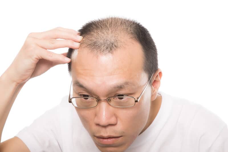 ストレスでハゲた男性